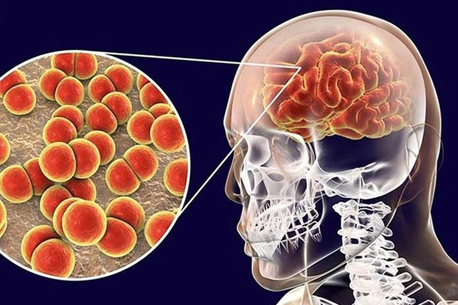 Tác nhân gây bệnh não mô cầu là vi khuẩn Neisseria meningitidis. Ảnh minh họa từ internet. 24-phong-benh-nao-mo-cau.jpg