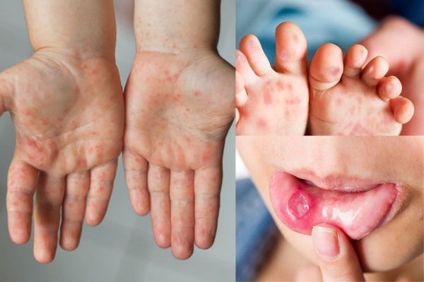 Khẩn: Đã có 5.545 ca tay chân miệng, Bộ Y tế dự báo dịch có thể gia tăng