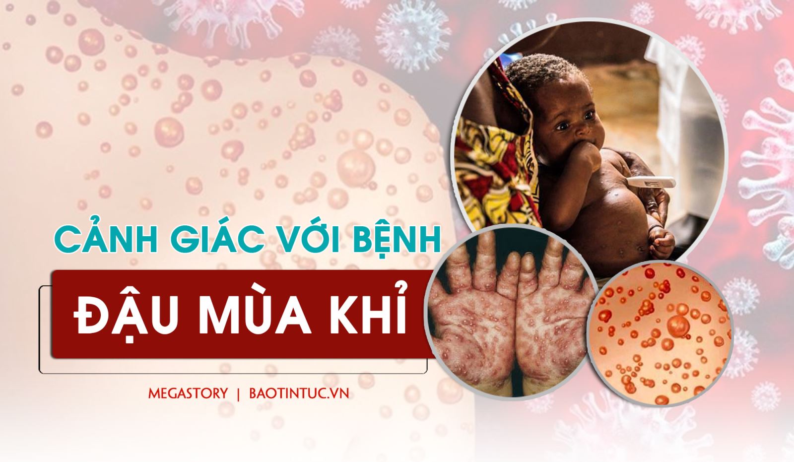 Diễn biến bệnh đậu mùa khỉ: Liệu kịch bản tương tự như COVID-19 có lặp lại?