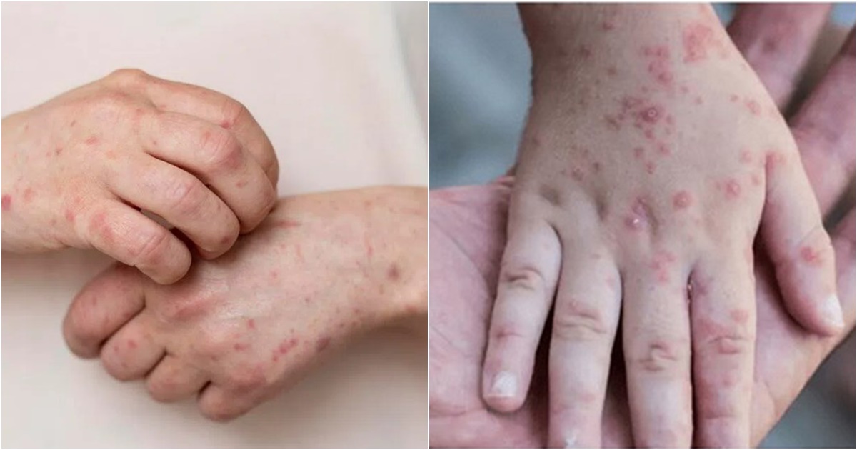 Việt Nam ghi nhận 56 trường hợp nhiễm đậu mùa khỉ, Bộ Y tế cảnh báo mầm bệnh đã xâm nhập trong cộng đồng