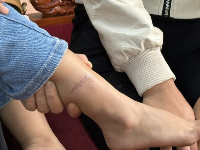 Không chủ quan với bệnh dại