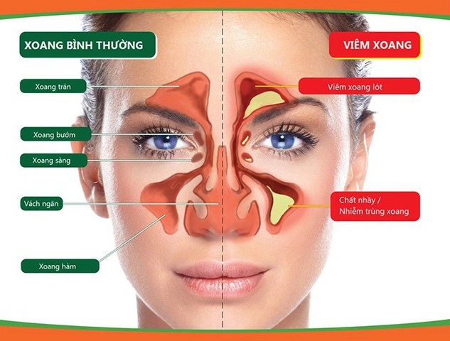 Trời mưa nồm ẩm, cảnh giác với viêm mũi xoang do nấm
