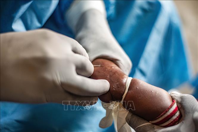 Chuyên gia Thái Lan khuyến nghị về vaccine phòng ngừa đậu mùa khỉ