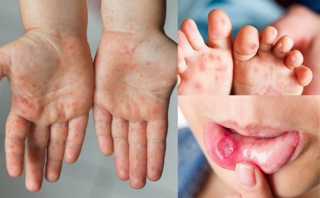 Khẩn: Đã có 5.545 ca tay chân miệng, Bộ Y tế dự báo dịch có thể gia tăng