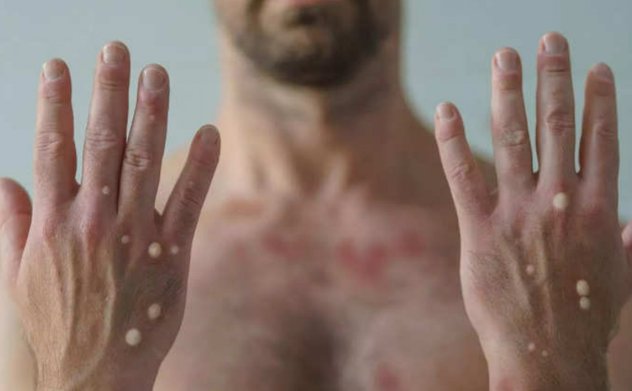 Trung Quốc phê duyệt thử nghiệm lâm sàng loại vaccine đầu tiên phòng bệnh đậu mùa khỉ 