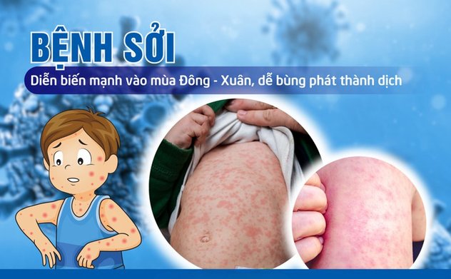 Thủ tướng yêu cầu tăng cường công tác phòng, chống bệnh sởi 